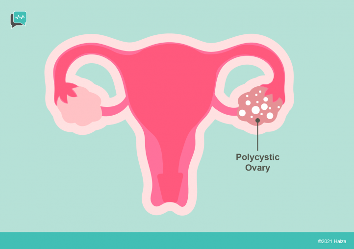 Polycystic Ovary Syndrome: Untangling the Web