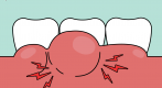 Gingivitis and Gum Disease