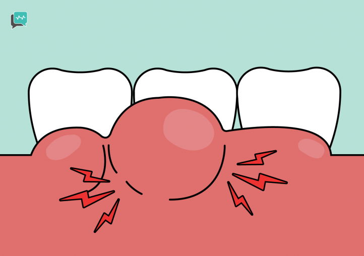 Gingivitis and Gum Disease
